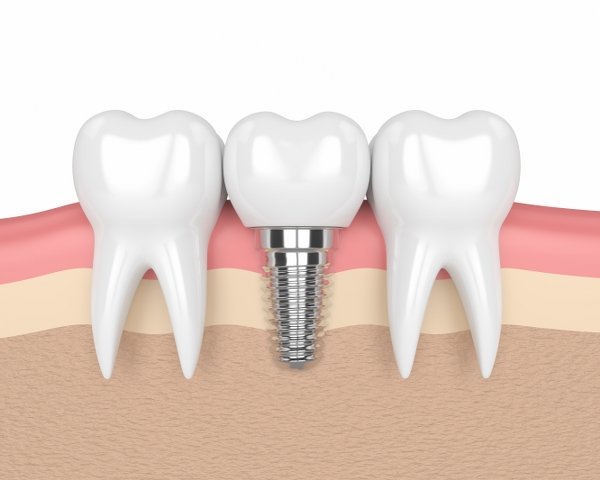Dental implants Ashford starlite dental finberry BISU